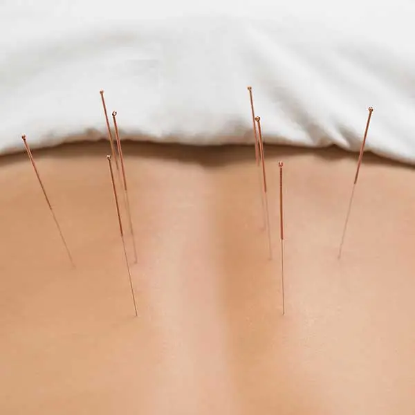 Akupunktur Bandscheibenvorfall